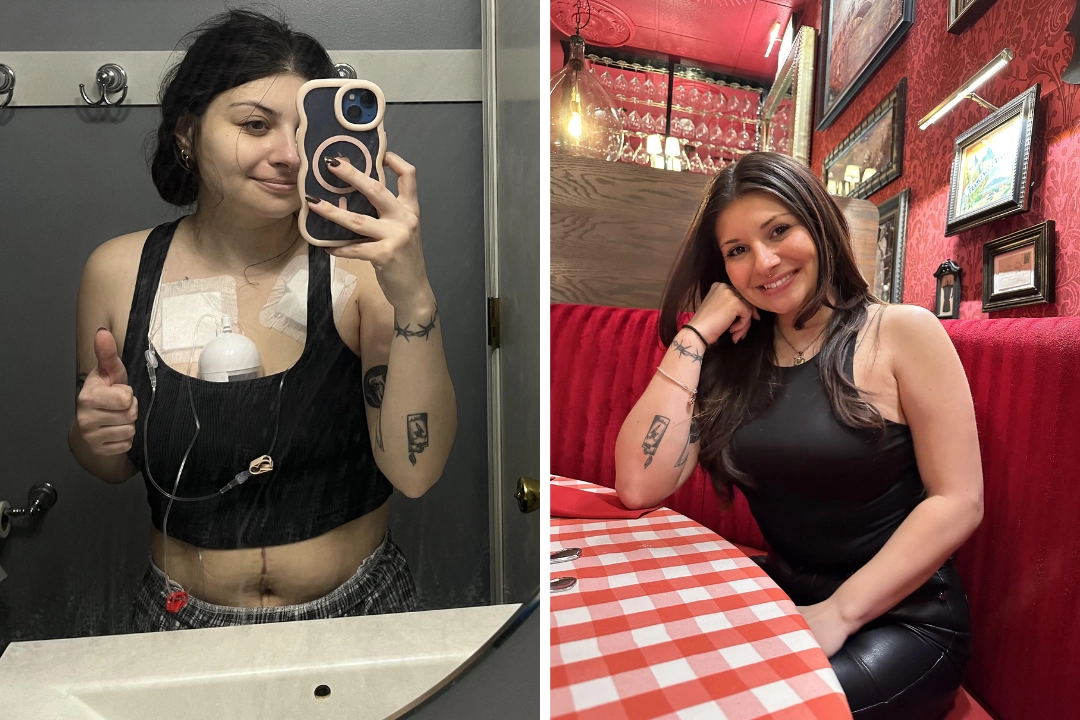 A 27-year-old woman ignored bloating and blood in her stool - only to be diagnosed with stage four colon cancer that cost her both ovaries and her chance of having children.