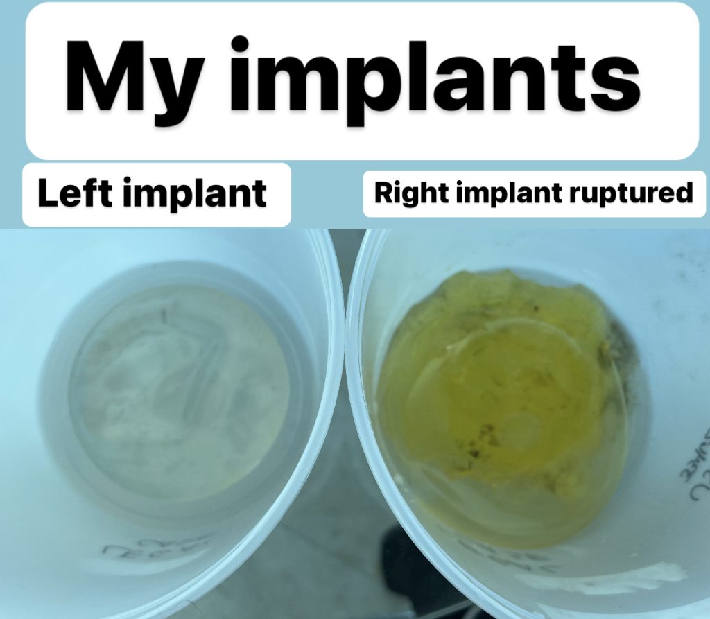 Carol Paredes was left paralysed and in a wheelchair after botched breast implants ruptured and leaked silicone through her body - needing open-heart surgery to survive the ordeal.