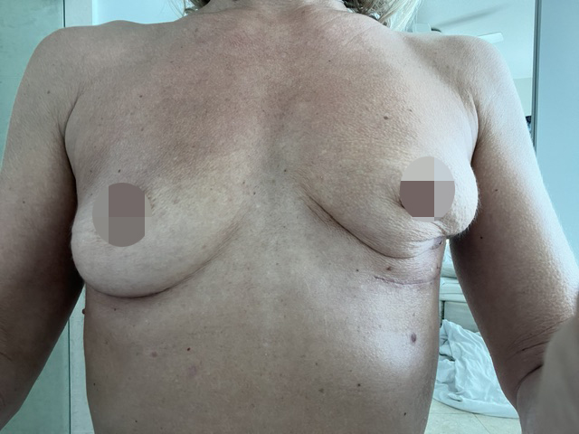 Carol Paredes was left paralysed and in a wheelchair after botched breast implants ruptured and leaked silicone through her body - needing open-heart surgery to survive the ordeal.