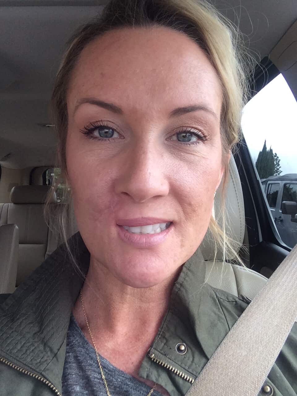 Mum Kory Feltz woke up paralysed during surgery as doctors cut cancer from her lip. After 20 years of skin cancer battles she warns others to never skip SPF or skin checks.