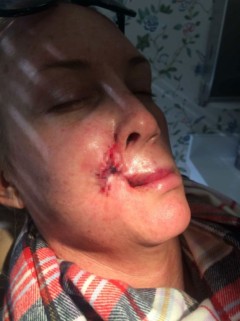 Mum Kory Feltz woke up paralysed during surgery as doctors cut cancer from her lip. After 20 years of skin cancer battles she warns others to never skip SPF or skin checks.
