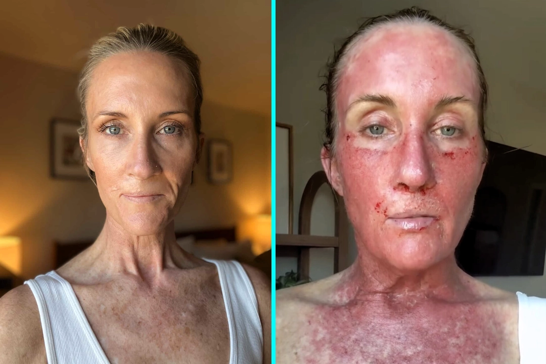 Mum Kory Feltz woke up paralysed during surgery as doctors cut cancer from her lip. After 20 years of skin cancer battles she warns others to never skip SPF or skin checks.