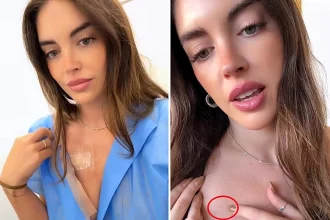 Chilean actress Coni Piccoli reveals skin cancer diagnosis after years of sun exposure without protection - blames tanning accelerators and urges fans to wear sunscreen.