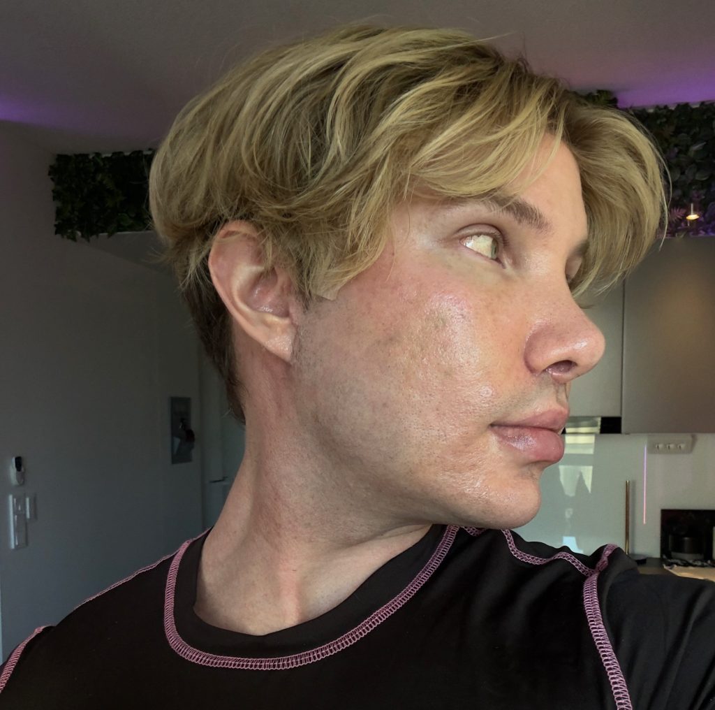 An influencer went temporarily blind and was left unrecognisable after an extreme facelift in South Korea - a procedure Turkish doctors had refused to perform on someone his age.