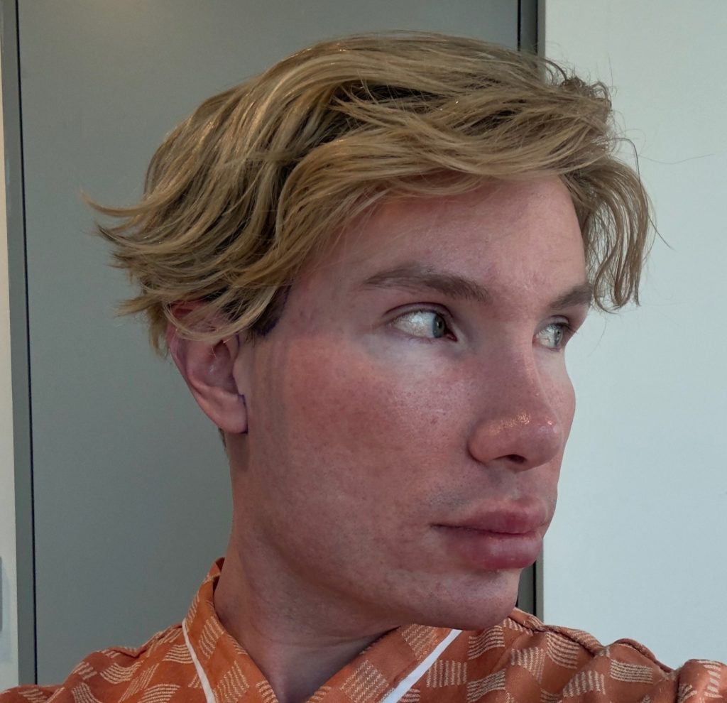 An influencer went temporarily blind and was left unrecognisable after an extreme facelift in South Korea - a procedure Turkish doctors had refused to perform on someone his age.