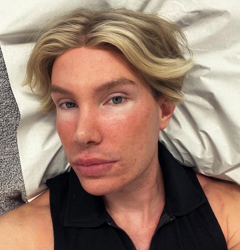 An influencer went temporarily blind and was left unrecognisable after an extreme facelift in South Korea - a procedure Turkish doctors had refused to perform on someone his age.