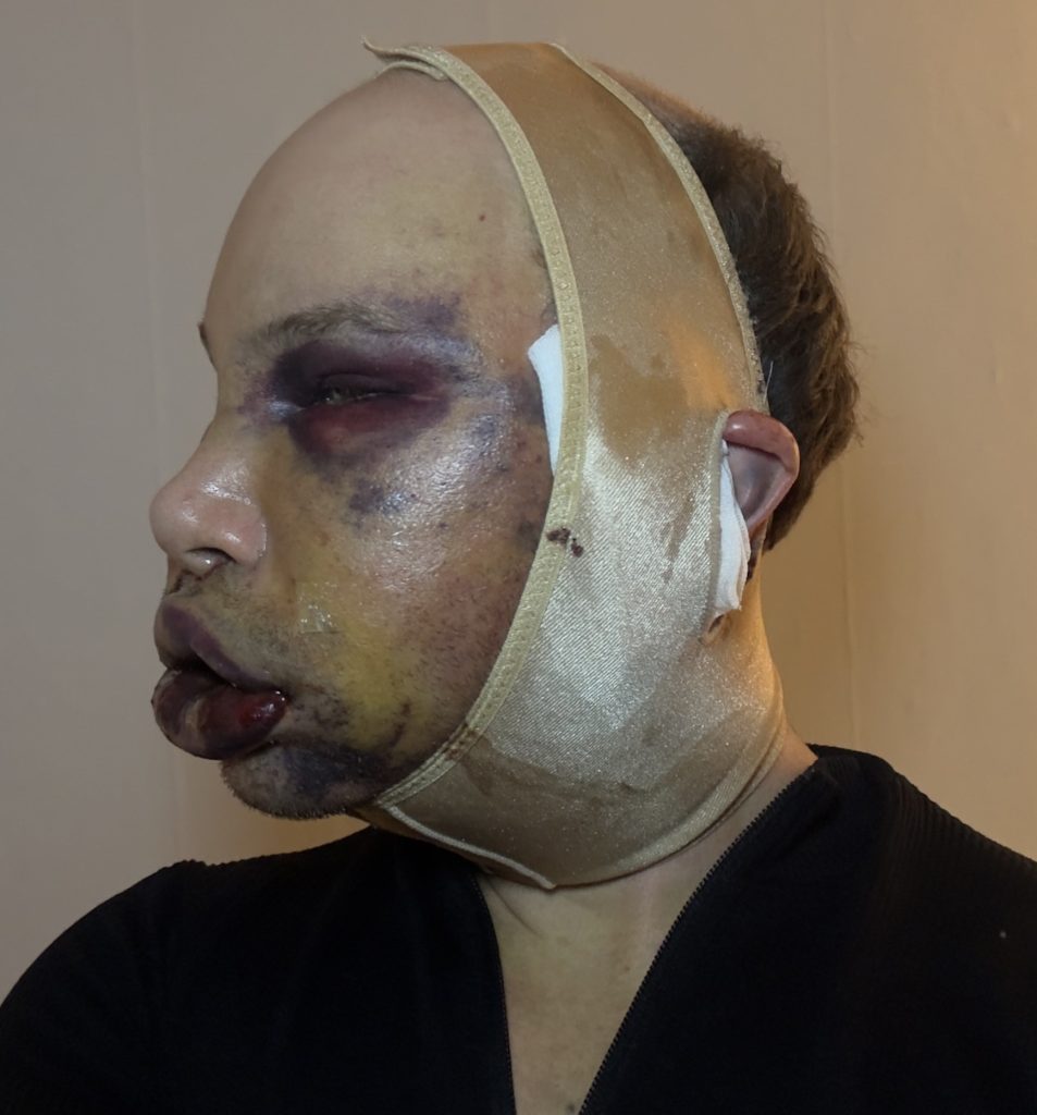 An influencer went temporarily blind and was left unrecognisable after an extreme facelift in South Korea - a procedure Turkish doctors had refused to perform on someone his age.