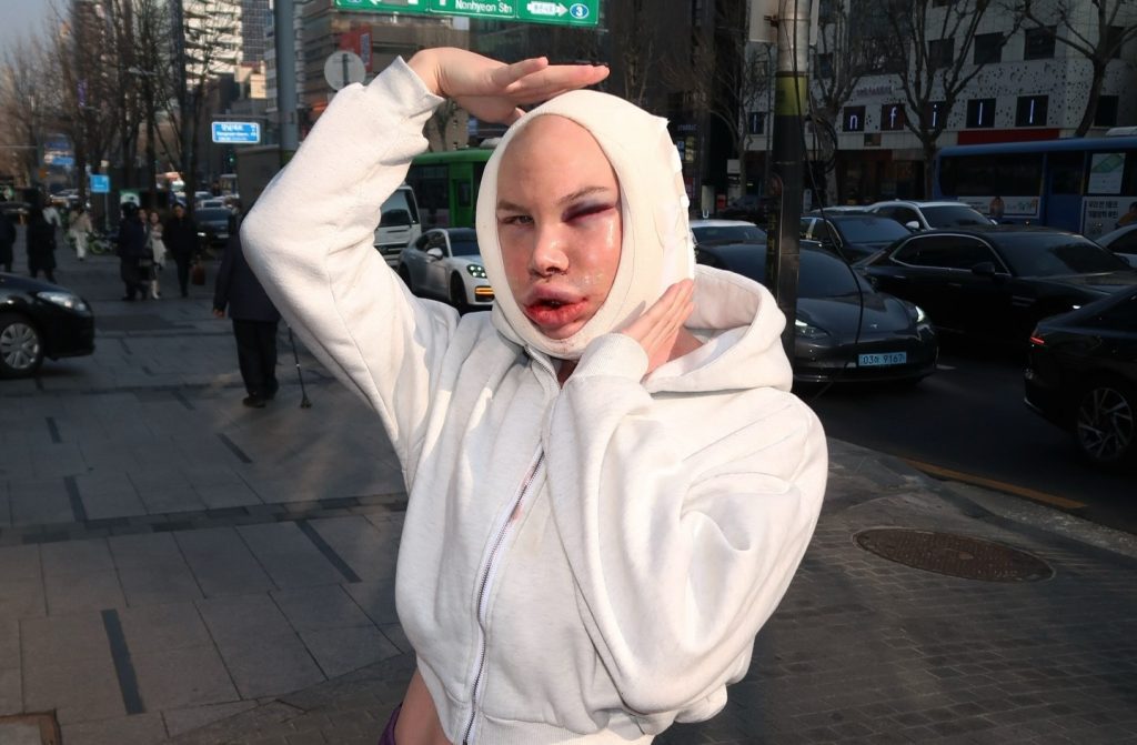 An influencer went temporarily blind and was left unrecognisable after an extreme facelift in South Korea - a procedure Turkish doctors had refused to perform on someone his age.
