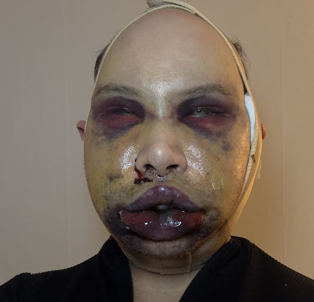 An influencer went temporarily blind and was left unrecognisable after an extreme facelift in South Korea - a procedure Turkish doctors had refused to perform on someone his age.