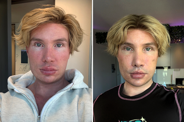 An influencer went temporarily blind and was left unrecognisable after an extreme facelift in South Korea - a procedure Turkish doctors had refused to perform on someone his age.