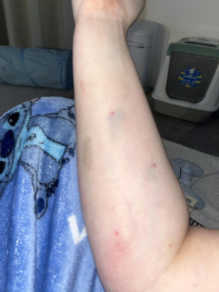 A veterinary nurse needed emergency surgery after a cat bite left her hand ballooned with infection - and is now warning others never to ignore animal bites.
