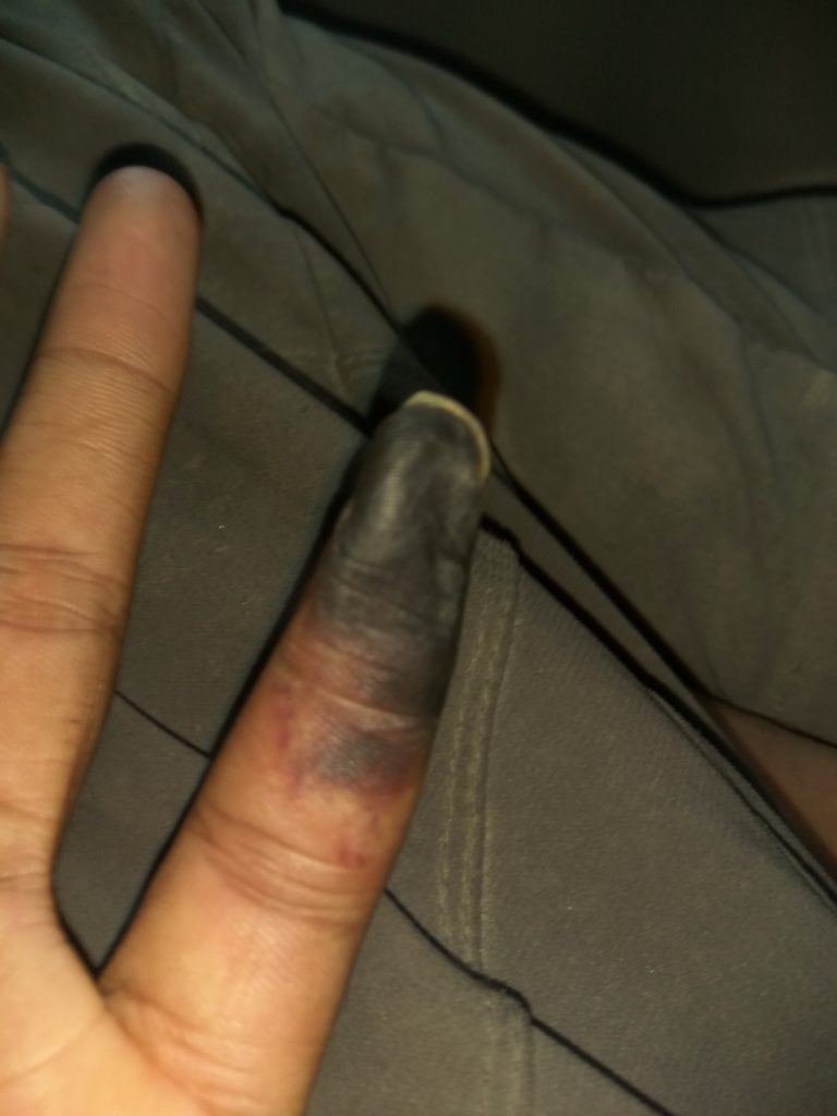 A mountaineer who scaled more than 30 peaks lost his finger on Everest after removing his glove for just four minutes in -35C conditions - and says the psychological toll was harder than the amputation.