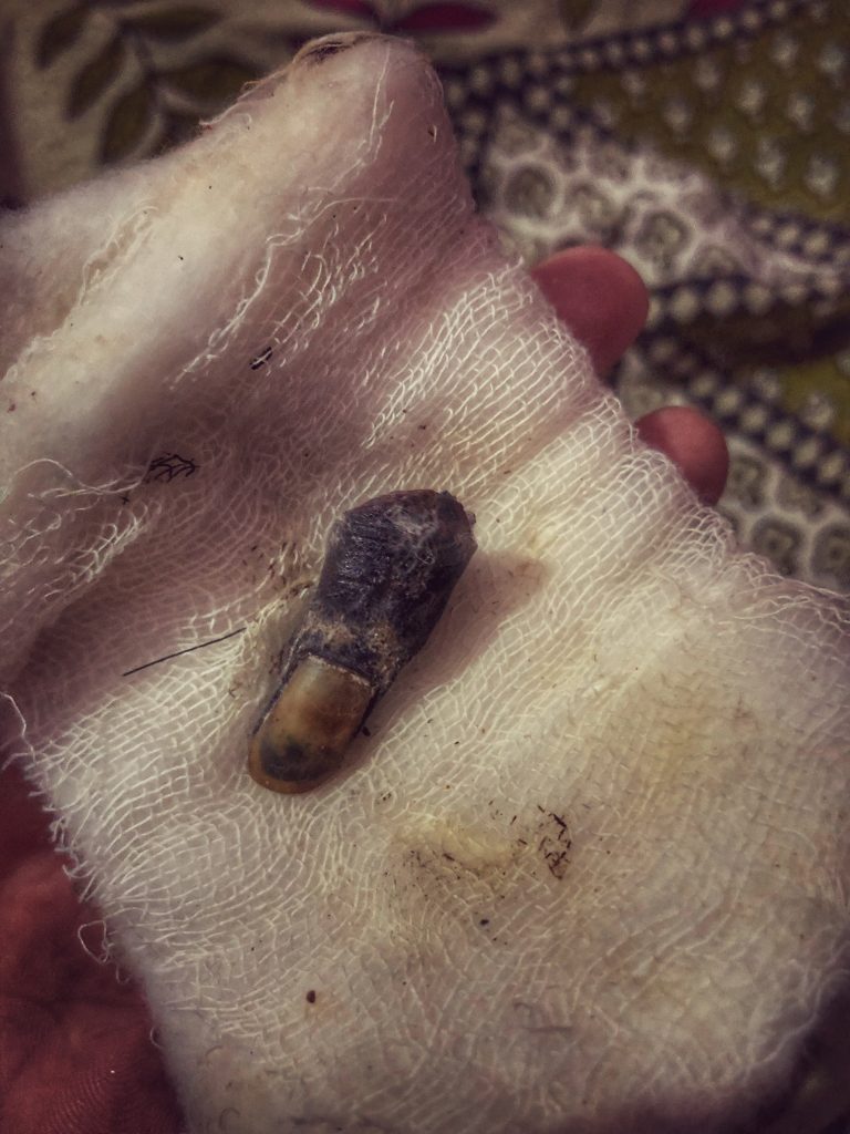 A mountaineer who scaled more than 30 peaks lost his finger on Everest after removing his glove for just four minutes in -35C conditions - and says the psychological toll was harder than the amputation.