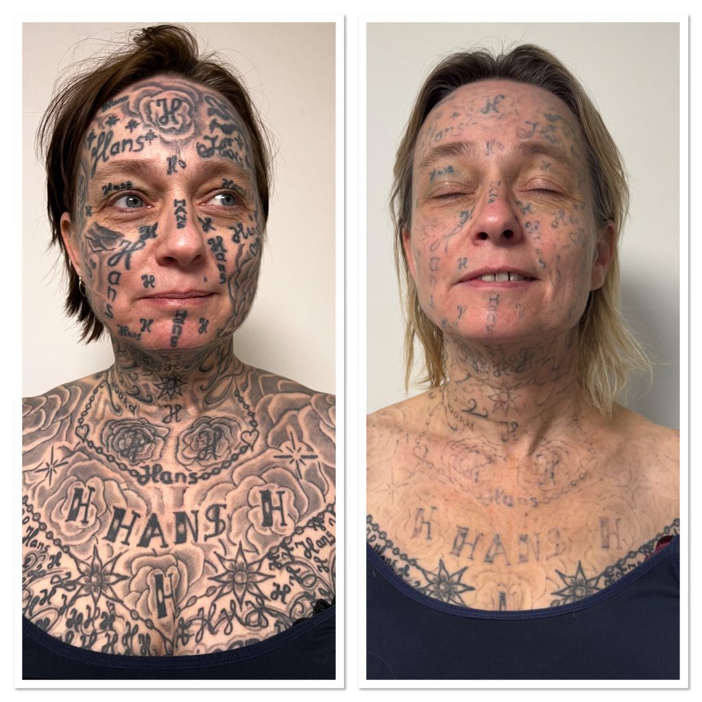 A woman says her abusive ex tattooed his name on her body over 250 times - including her face. A charity is now helping her remove every mark and reclaim her identity.