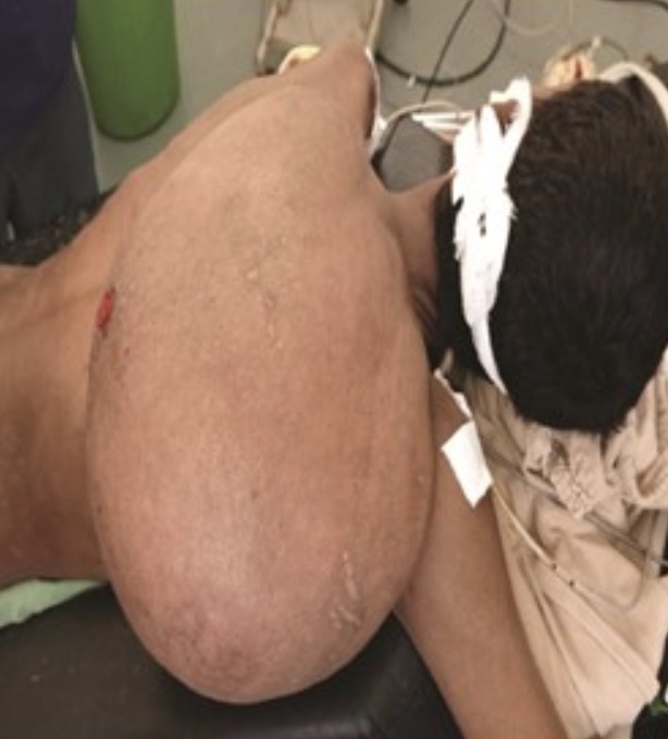 A man had a 25kg lipoma surgically removed from his neck after the benign tumour grew so large it left him unable to socialise, work his farm or wear his own clothes for years.