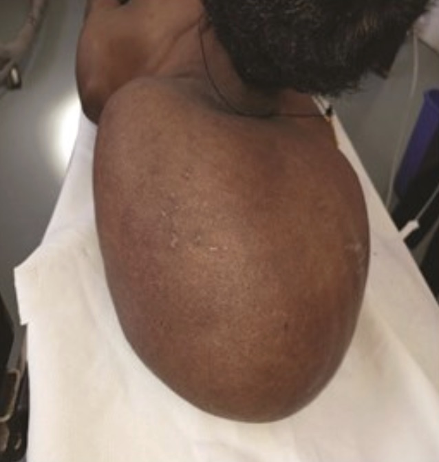 A man had a 25kg lipoma surgically removed from his neck after the benign tumour grew so large it left him unable to socialise, work his farm or wear his own clothes for years.