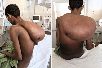A man had a 25kg lipoma surgically removed from his neck after the benign tumour grew so large it left him unable to socialise, work his farm or wear his own clothes for years.
