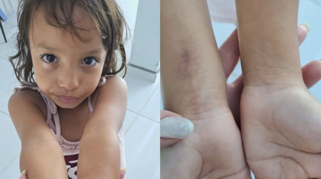 A five-year-old Brazilian girl was buried alive by her mother and stepfather, a forensic report confirmed, finding soil in her airway proving she was still breathing when entombed.