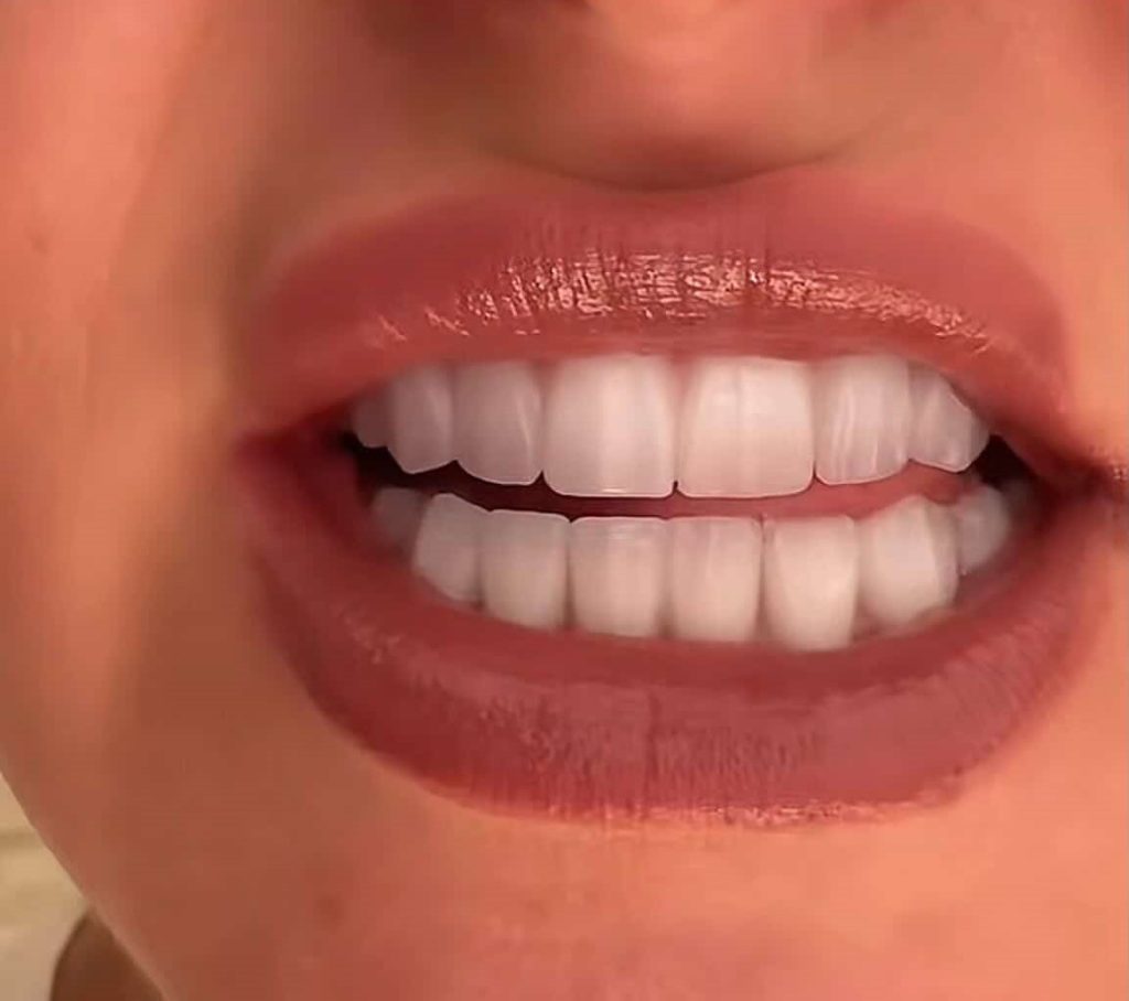 A woman who spent £8,000 on Turkey teeth was left with stumps for six months and mocked for looking 80, but says the completed results have finally ended years of insecurity.