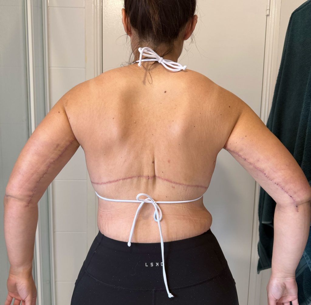 Quoted $100,000 for skin removal surgery after losing 187lbs, Codie McGovern flew 4,500 miles to Thailand and got it done for $28,000, and it changed everything.