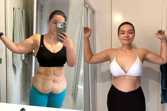 Quoted $100,000 for skin removal surgery after losing 187lbs, Codie McGovern flew 4,500 miles to Thailand and got it done for $28,000, and it changed everything.