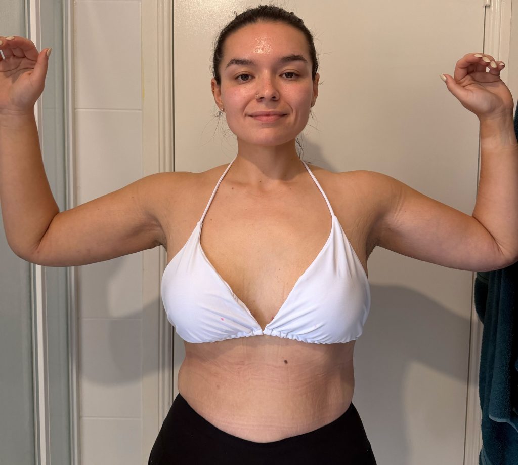 Quoted $100,000 for skin removal surgery after losing 187lbs, Codie McGovern flew 4,500 miles to Thailand and got it done for $28,000, and it changed everything.