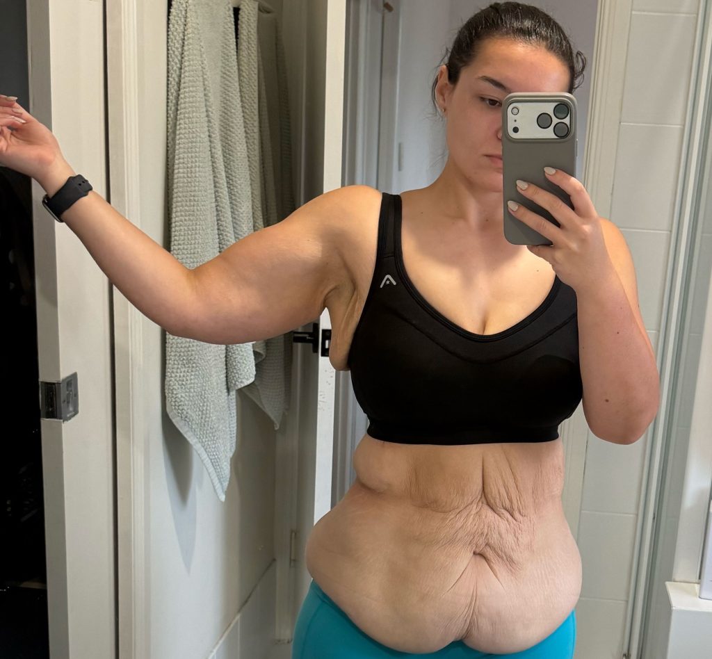 Quoted $100,000 for skin removal surgery after losing 187lbs, Codie McGovern flew 4,500 miles to Thailand and got it done for $28,000, and it changed everything.