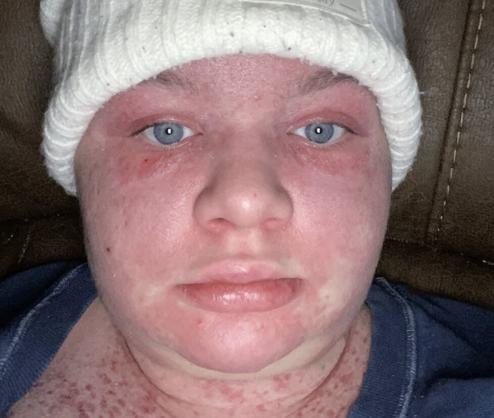 A 24-year-old with a rare sun allergy says just 15 seconds of UV exposure can cause her skin to burn, blister and peel off - leaving her unable to step outside without full body armour.