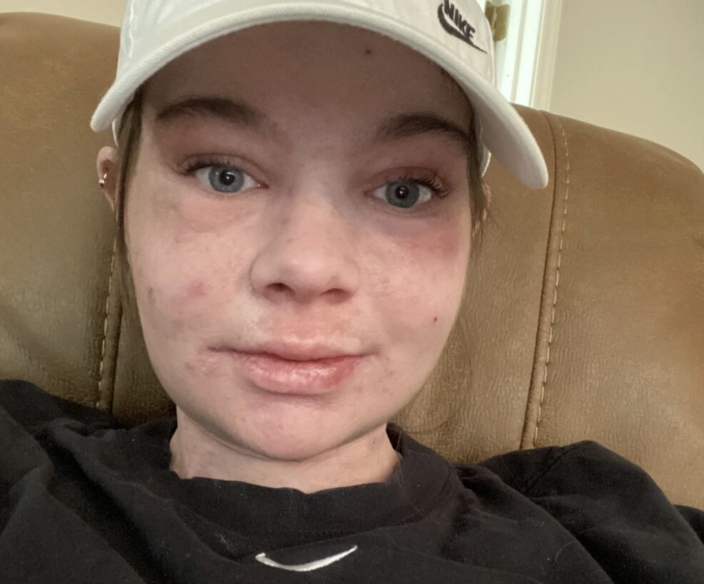 A 24-year-old with a rare sun allergy says just 15 seconds of UV exposure can cause her skin to burn, blister and peel off - leaving her unable to step outside without full body armour.