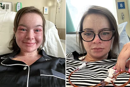 A 24-year-old with a rare sun allergy says just 15 seconds of UV exposure can cause her skin to burn, blister and peel off - leaving her unable to step outside without full body armour.