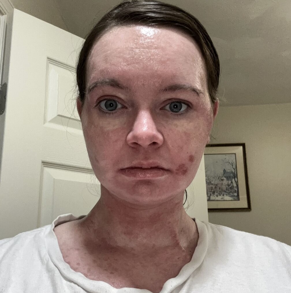 A 24-year-old with a rare sun allergy says just 15 seconds of UV exposure can cause her skin to burn, blister and peel off - leaving her unable to step outside without full body armour.