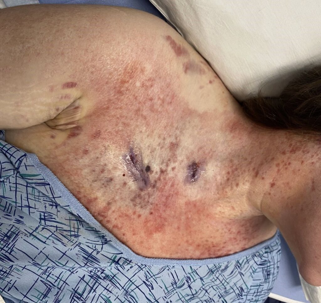 A 24-year-old with a rare sun allergy says just 15 seconds of UV exposure can cause her skin to burn, blister and peel off - leaving her unable to step outside without full body armour.