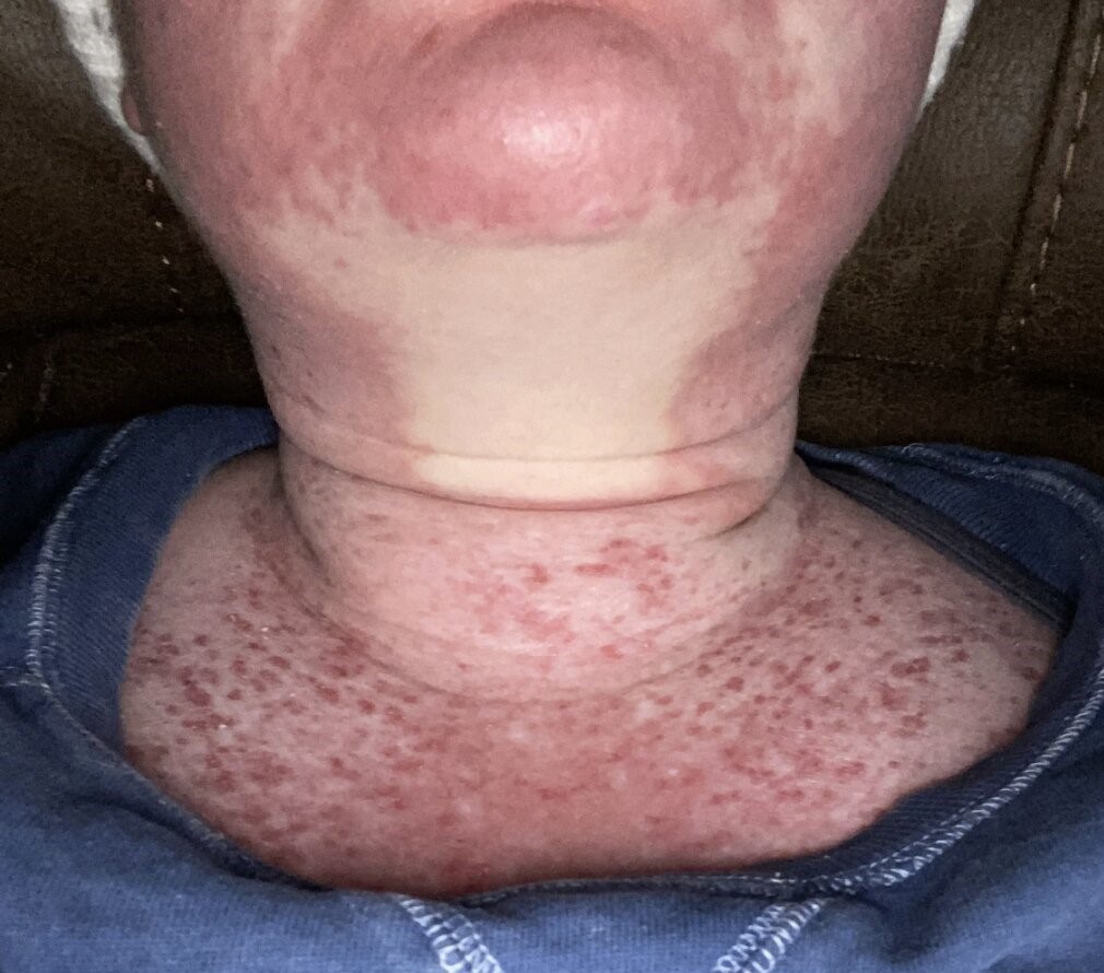 A 24-year-old with a rare sun allergy says just 15 seconds of UV exposure can cause her skin to burn, blister and peel off - leaving her unable to step outside without full body armour.