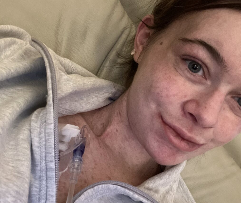 A 24-year-old with a rare sun allergy says just 15 seconds of UV exposure can cause her skin to burn, blister and peel off - leaving her unable to step outside without full body armour.