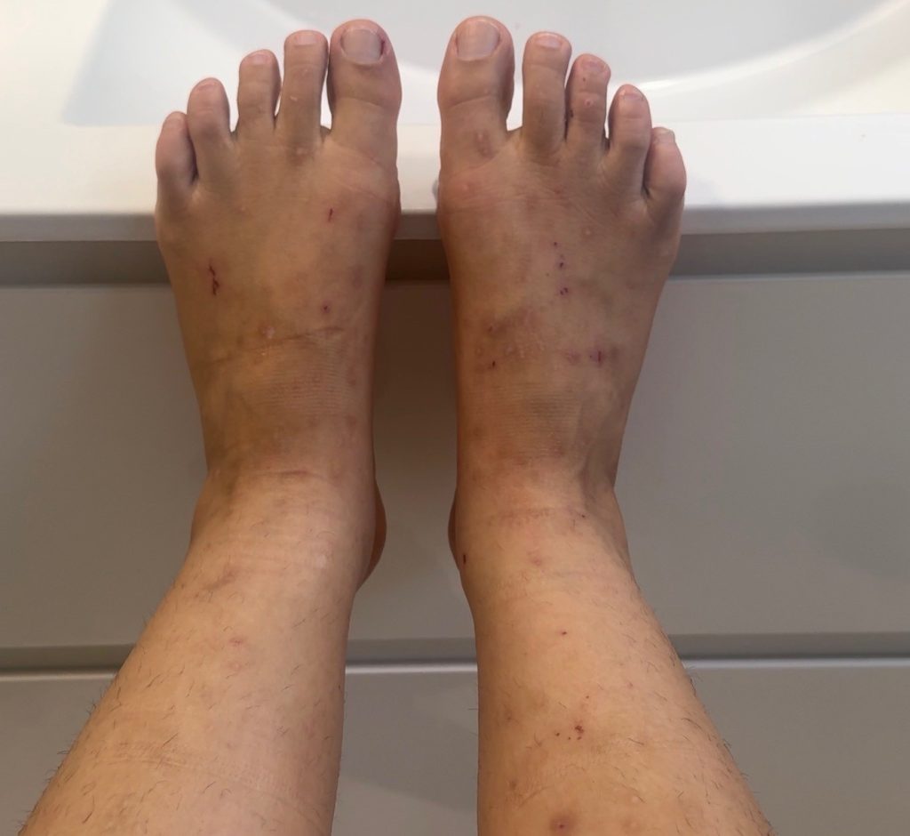 A woman who spent 11 months itching herself to death self-diagnosed her own cancer after doctors dismissed her symptoms as dry skin - and she was right.