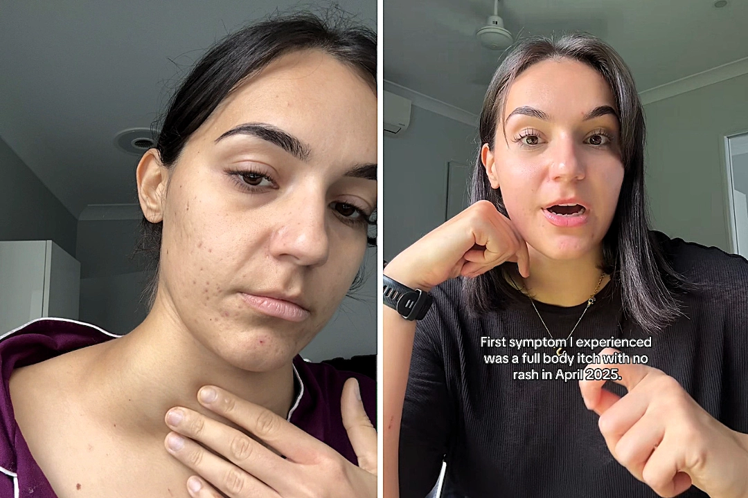 A woman who spent 11 months itching herself to death self-diagnosed her own cancer after doctors dismissed her symptoms as dry skin - and she was right.