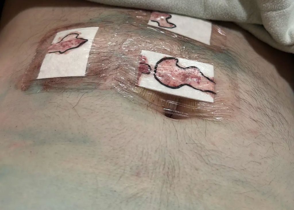 A man left his wife and kids behind to fly to Taiwan for surgery after a botched mesh procedure left him unable to walk - here is his shocking story.