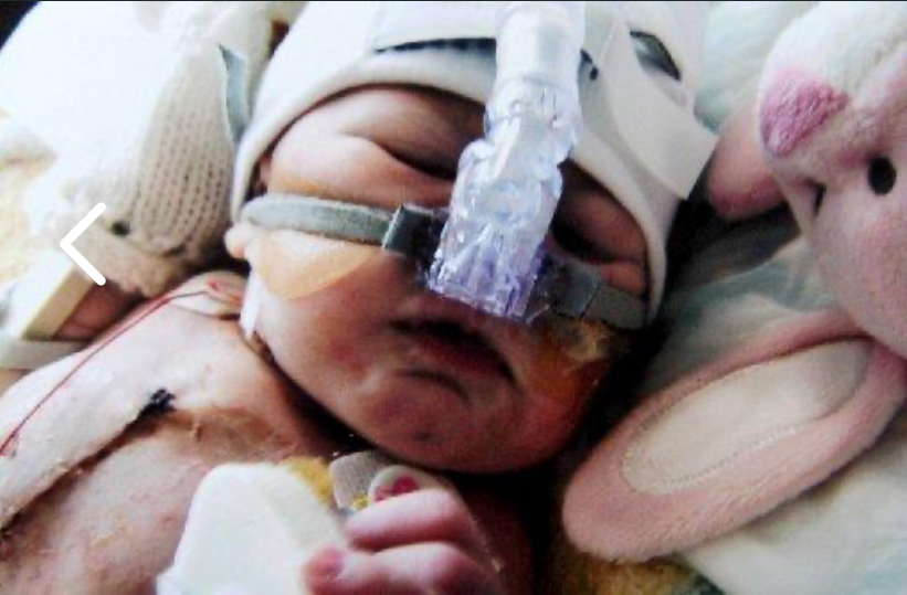 Teen who survived five open-heart surgeries as a child is now three inches taller after a life-changing spinal operation - and her mum's reaction left her in tears of joy.