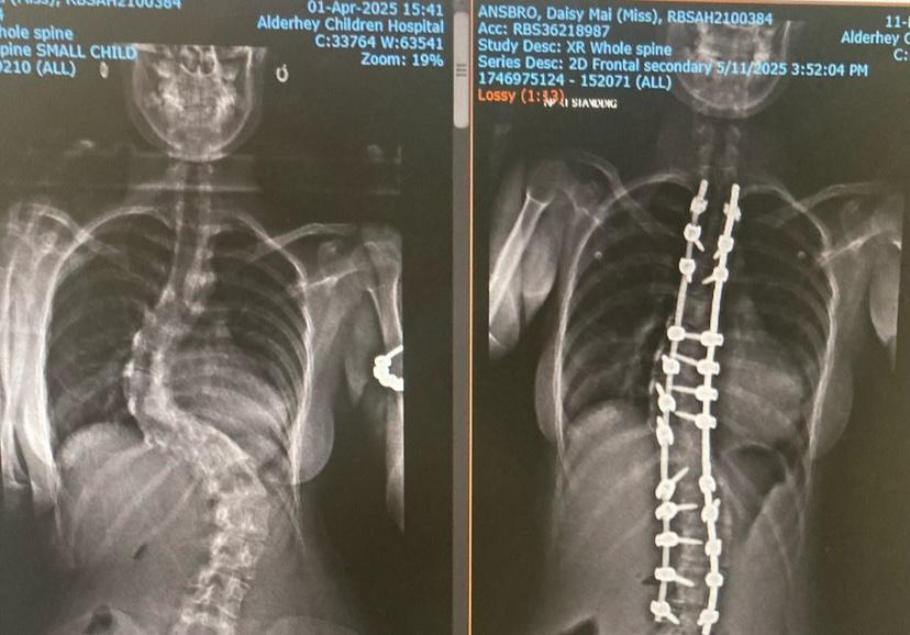 Teen who survived five open-heart surgeries as a child is now three inches taller after a life-changing spinal operation - and her mum's reaction left her in tears of joy.