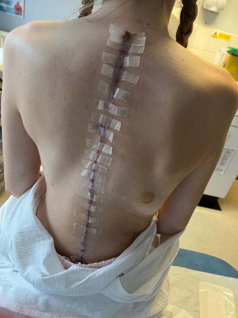 Teen who survived five open-heart surgeries as a child is now three inches taller after a life-changing spinal operation - and her mum's reaction left her in tears of joy.