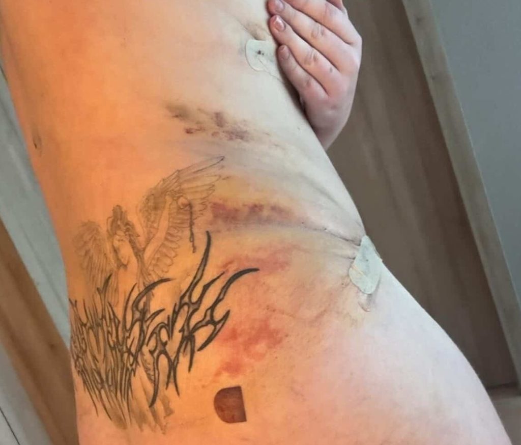 A woman woke up from surgery abroad to find her tattoos had vanished - and it was her boyfriend who spotted they were gone before she even noticed.