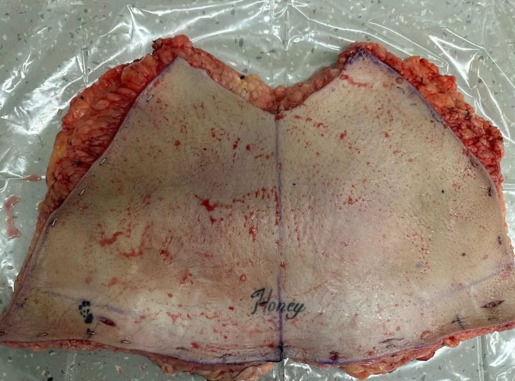 A woman woke up from surgery abroad to find her tattoos had vanished - and it was her boyfriend who spotted they were gone before she even noticed.