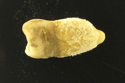 Scientists have reconstructed a 700-year-old strep infection genome from a medieval tooth, revealing the deadly bacteria was infecting humans centuries earlier than previously known.