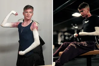 Peter Mesits lives with a rare butterfly skin disease where showers feel like nails and brushing teeth causes blisters. The 21-year-old says it will never defeat him.