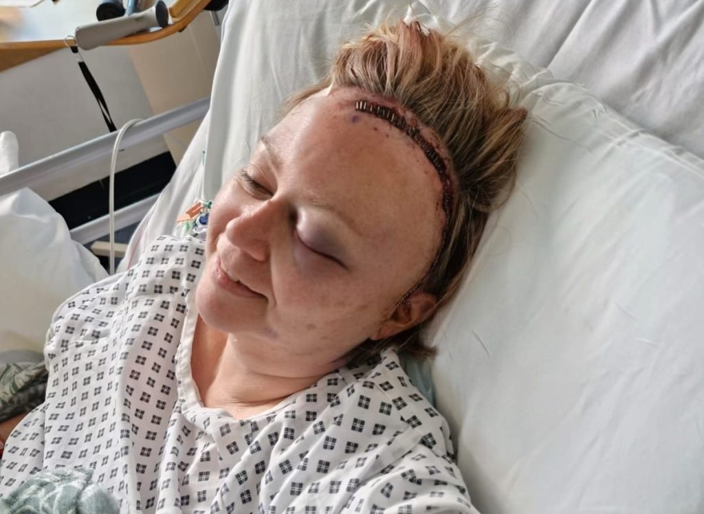 Nurse Mandy Park's brain aneurysm symptoms were hidden by menopause for years - until a thunderclap headache at work caused a rupture that needed emergency brain surgery.