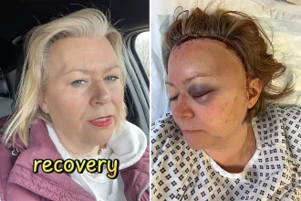 Nurse Mandy Park's brain aneurysm symptoms were hidden by menopause for years - until a thunderclap headache at work caused a rupture that needed emergency brain surgery.