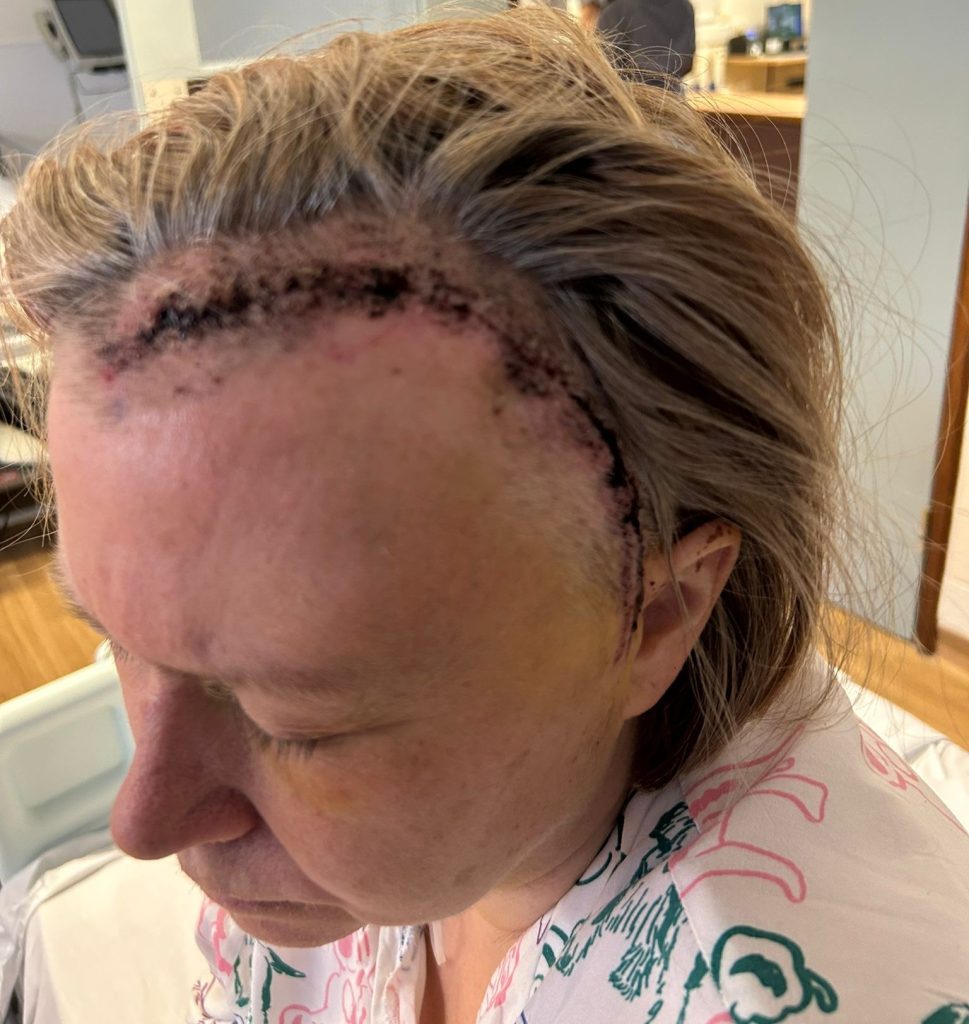 Nurse Mandy Park's brain aneurysm symptoms were hidden by menopause for years - until a thunderclap headache at work caused a rupture that needed emergency brain surgery.