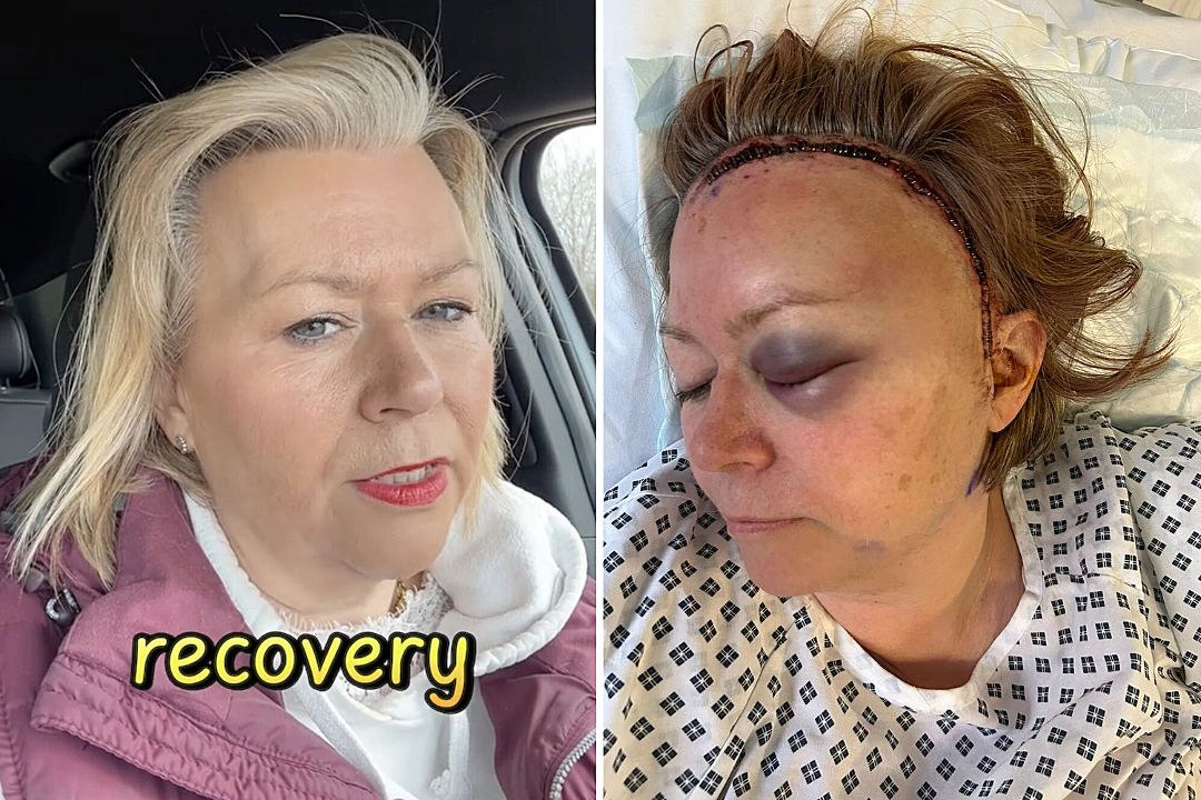 Nurse Mandy Park's brain aneurysm symptoms were hidden by menopause for years - until a thunderclap headache at work caused a rupture that needed emergency brain surgery.