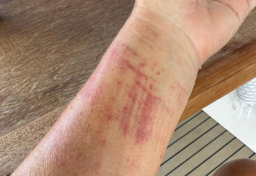 A tourist was dragged 32ft down the street by scooter robbers who tried to snatch her bag in Sint Maarten. Sarah Hertens says it felt like her arm was being pulled from its socket.