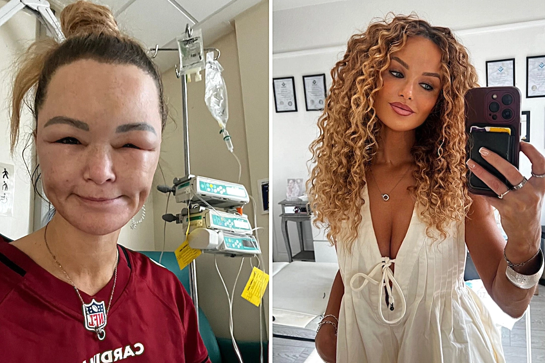 PE teacher Claire Titterington woke up blind from swelling after a minor car crash triggered a rare life-threatening condition that left her unrecognisable for years.